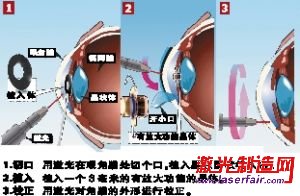 英激光新技术校正老花眼